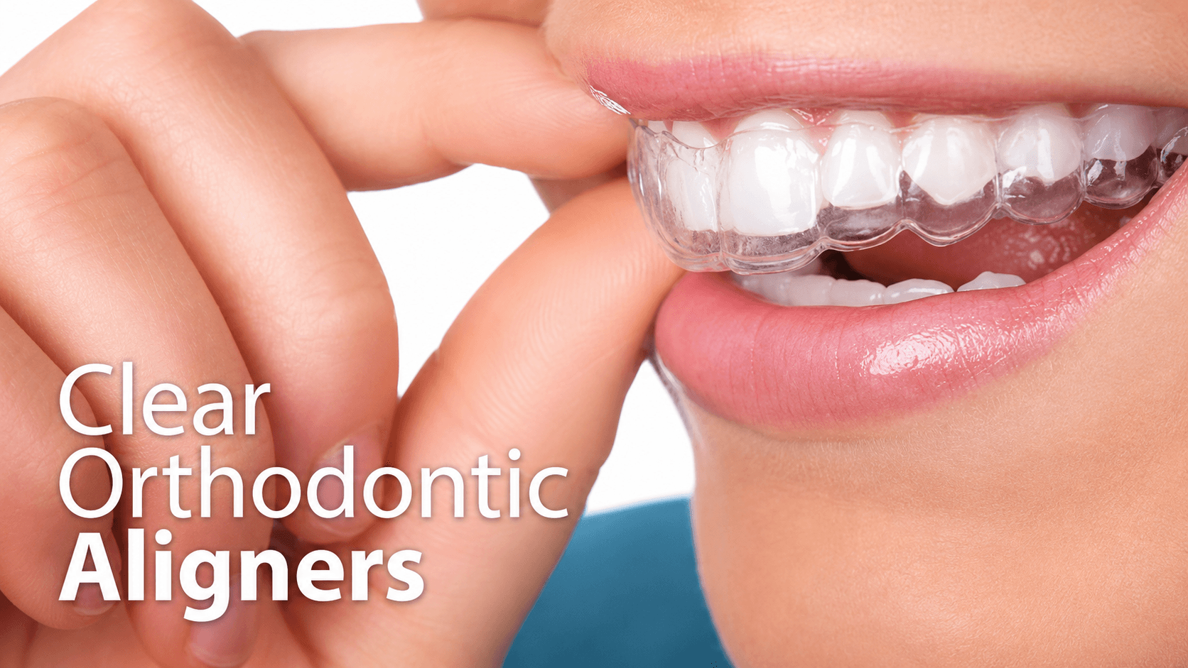 Dental Aligners