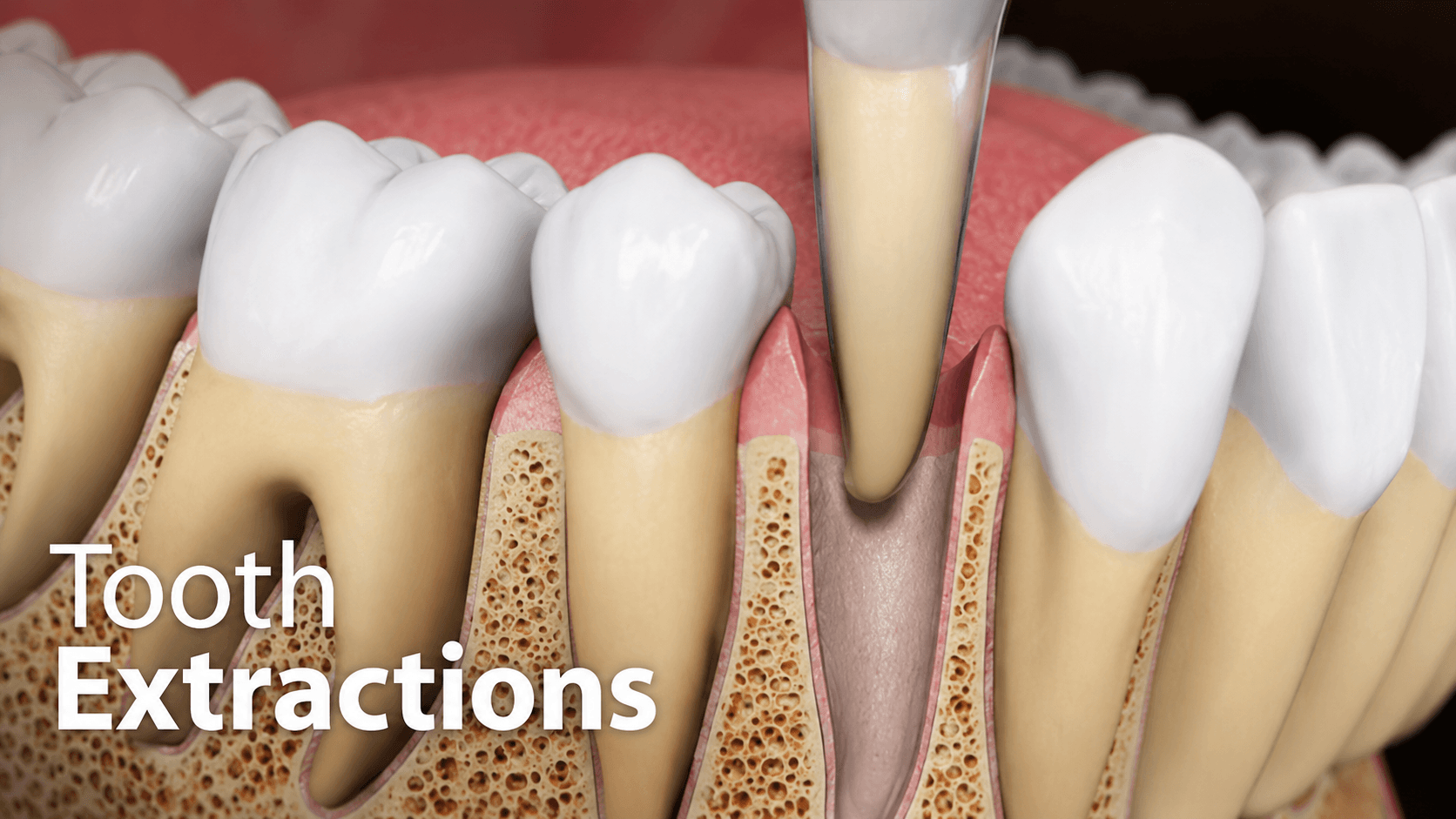 Extractions